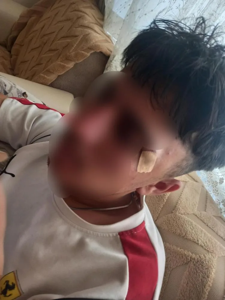 Öğretmenin kafa attığı çocuğun burnu kırıldı! 2 Öğretmenin kafa attığı çocuğun burnu kırıldı!